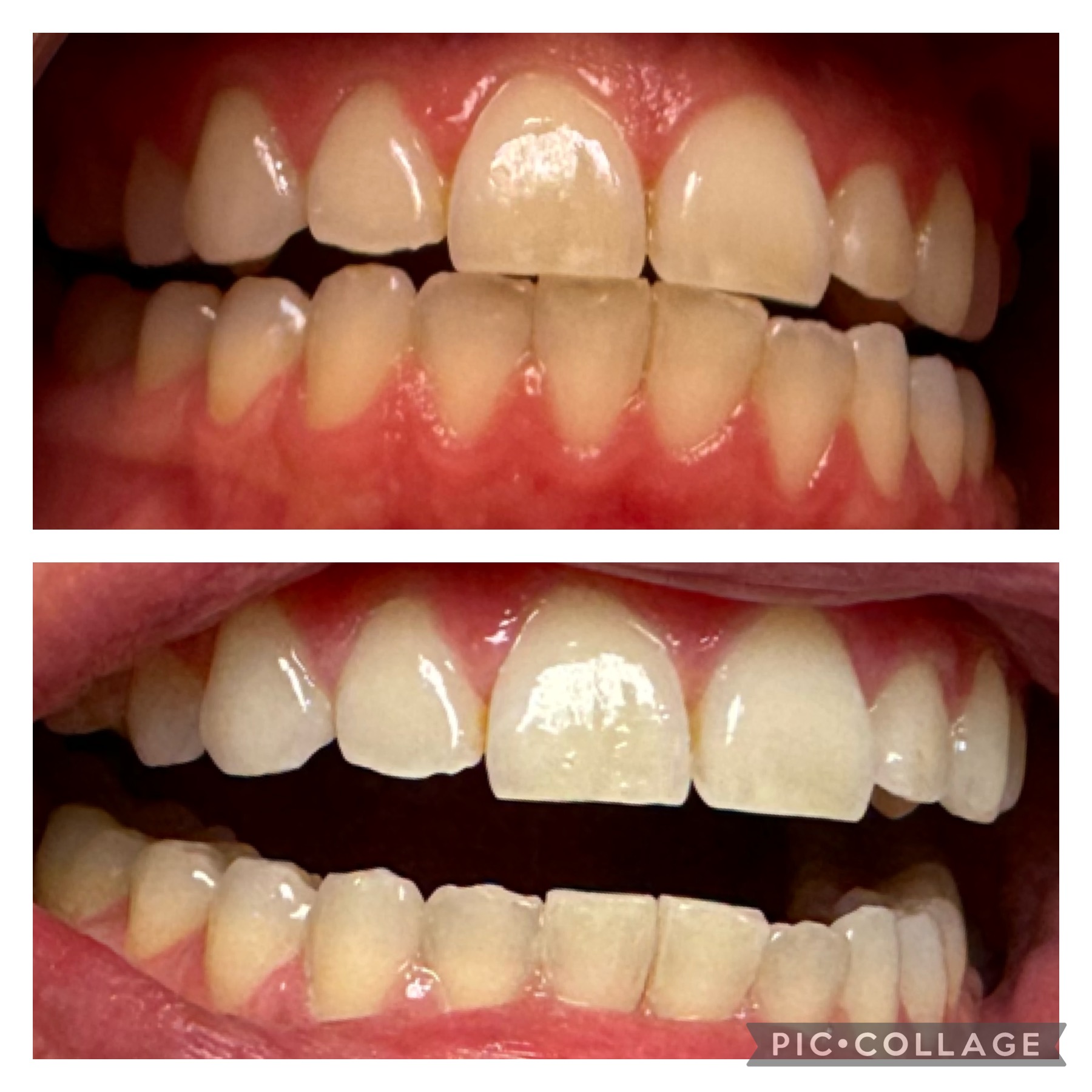 Before and after teeth whitening result 1 — 6 shades whiter