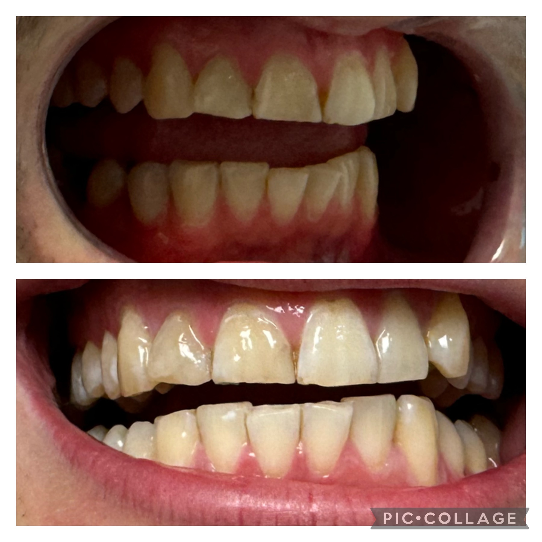 Before and after teeth whitening result 2 — 7 shades whiter