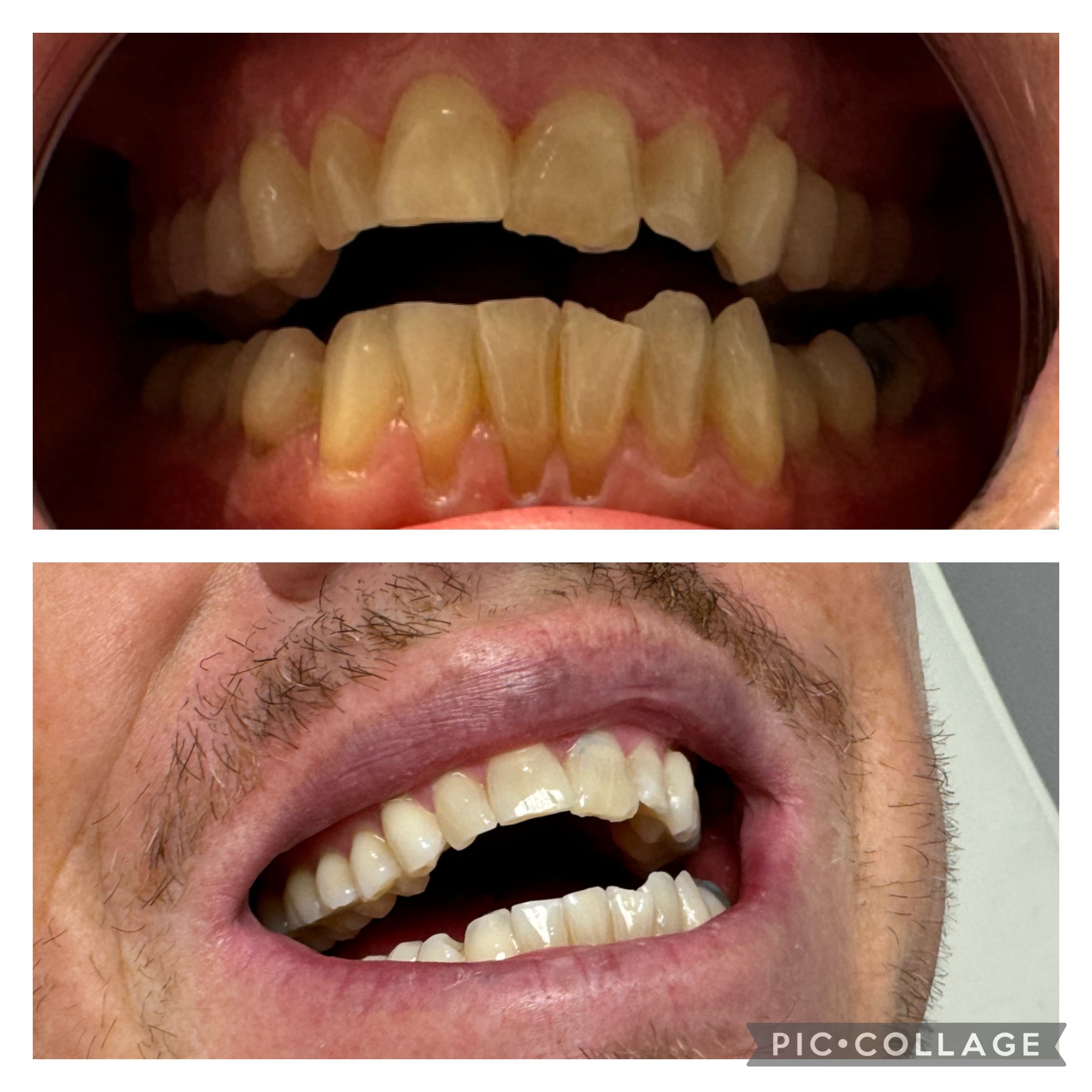 Before and after teeth whitening result 3 — 9 shades whiter