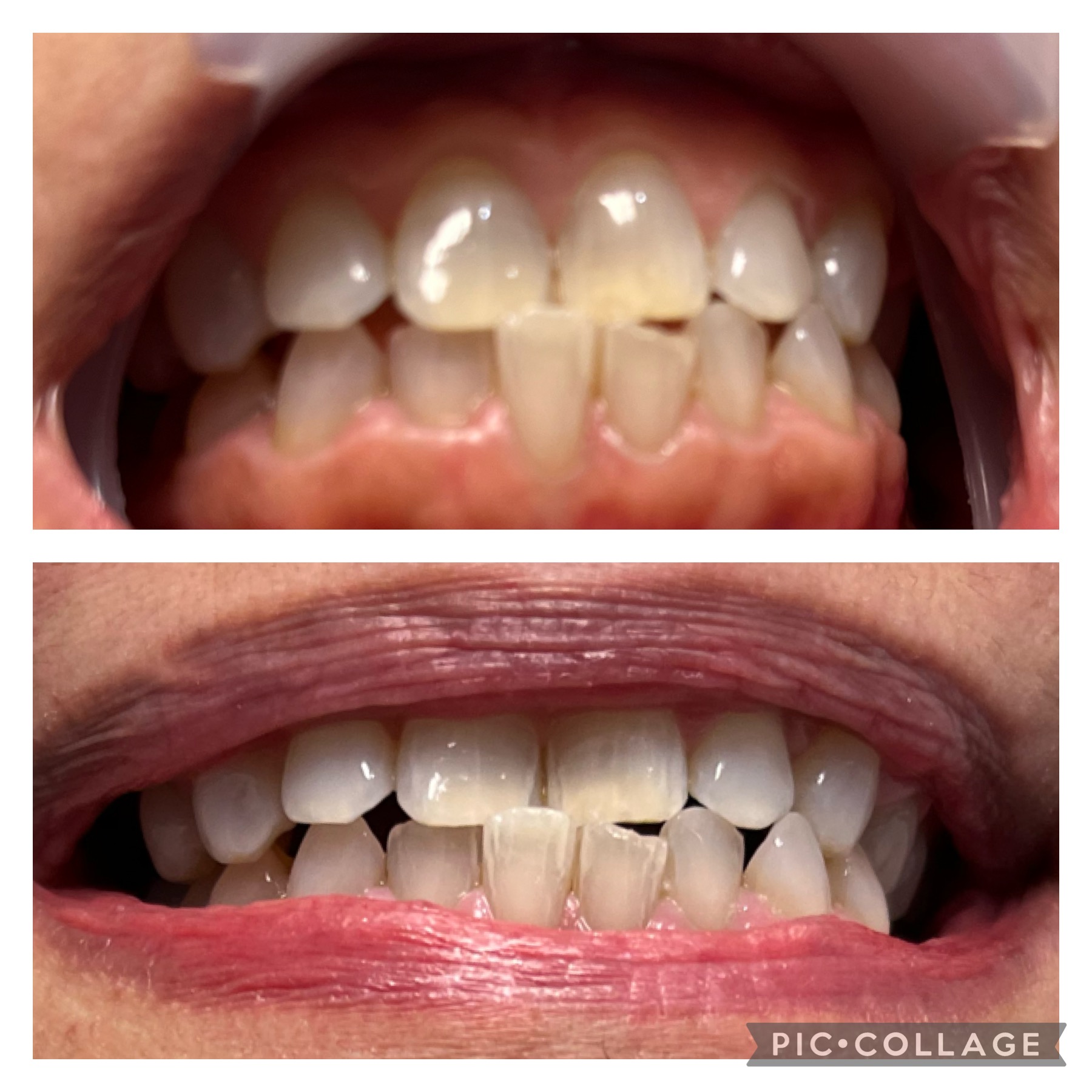 Before and after teeth whitening result 6 — 5 shades whiter